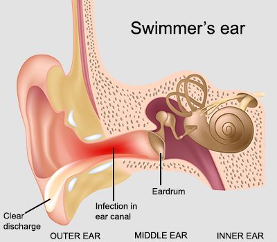 How to Relieve Ear Pain After Swimming