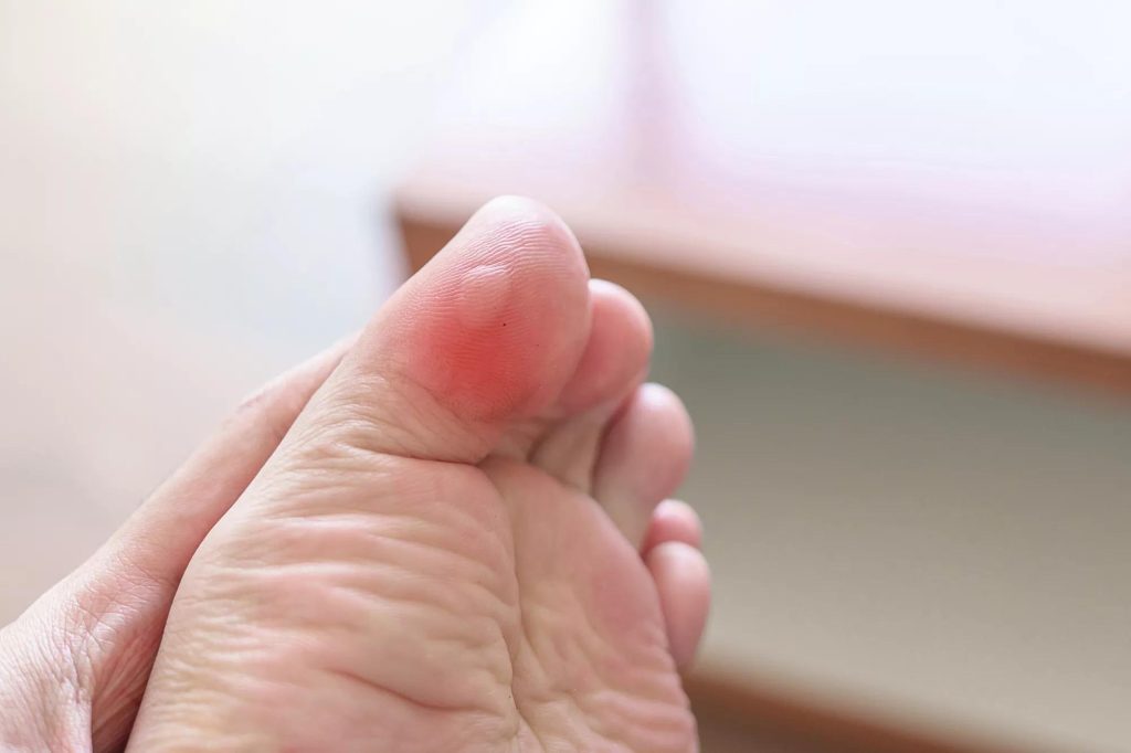 How to Stop Blister from Forming from Badminton